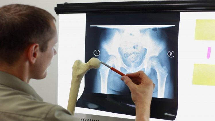 The doctor examines an x-ray for hip osteoarthritis